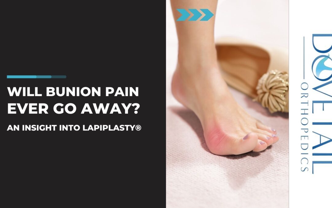 Will Bunion Pain Ever Go Away? An Insight into Lapiplasty®.