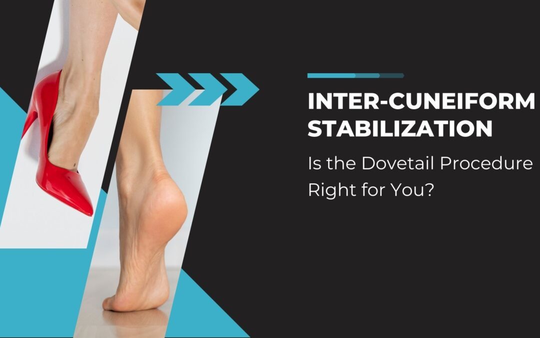 Promotional graphic for a blog post titled 'Inter-Cuneiform Stabilization: Is the Dovetail Procedure Right for You?' featuring a split background; on the left, a woman's foot in a red high-heel shoe symbolizing foot pain, and on the right, a bare foot representing post-procedure relief. Arrows point from the high heel towards the bare foot, indicating the transition from discomfort to stability.