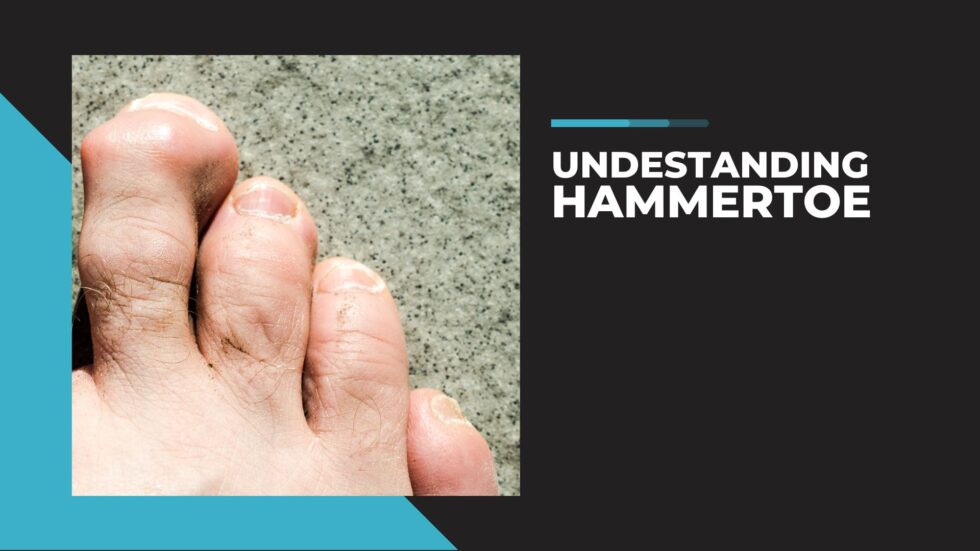 Hammertoe Types, Symptoms, Causes, And The Treatments - Dovetail ...