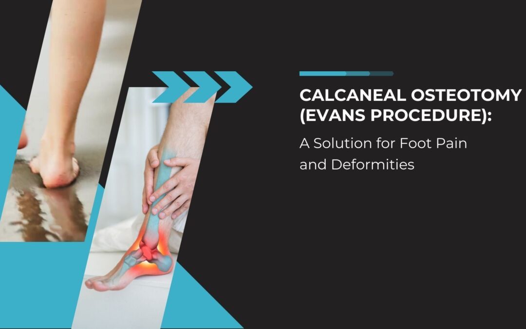 Calcaneal Osteotomy (Evans Procedure): A Solution for Foot Pain and Deformities