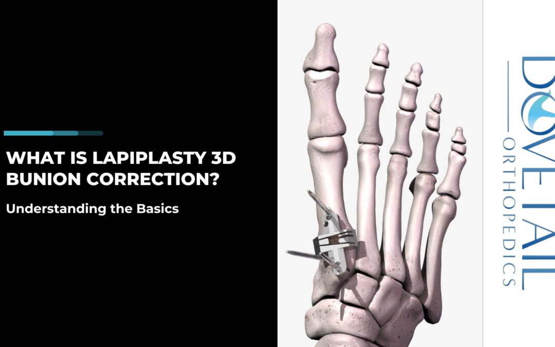 What is Lapiplasty 3d Bunion Correction