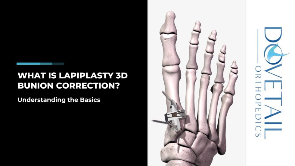 Video Explanation: What is Lapiplasty 3d Bunion Correction