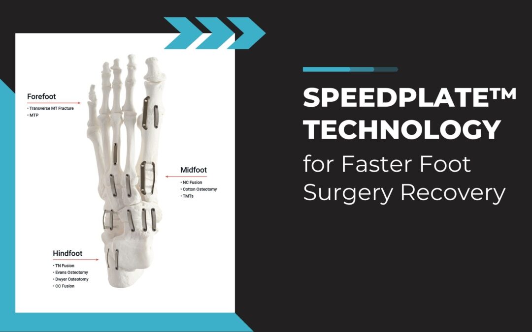 SpeedPlate™ Rapid Compression Implant Technology: Designed to Revolutionize Foot Surgery Recovery