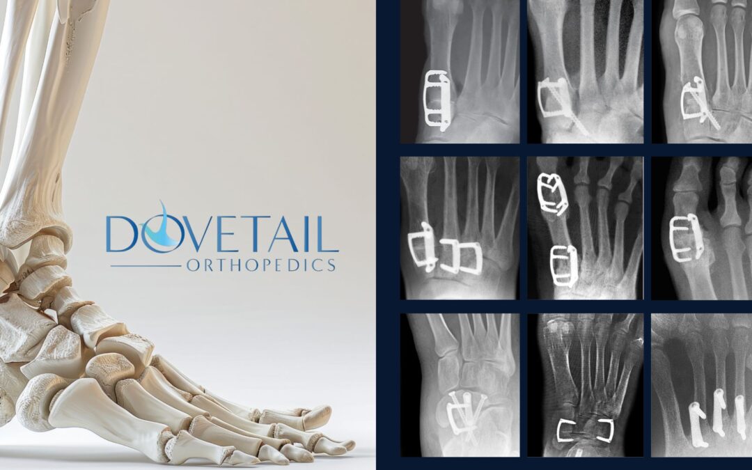 SpeedPlate™ Applications in Foot Surgery